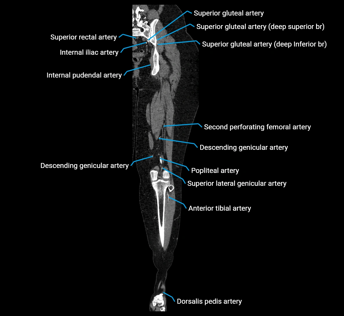 CTA lower limb coronal cross sectional anatomy labelled image _53 (2).webp